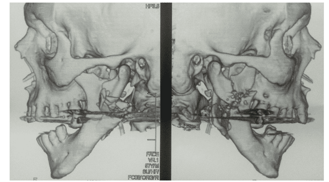 Subir une fracture bilatérale des testicules – Réalités Biomédicales