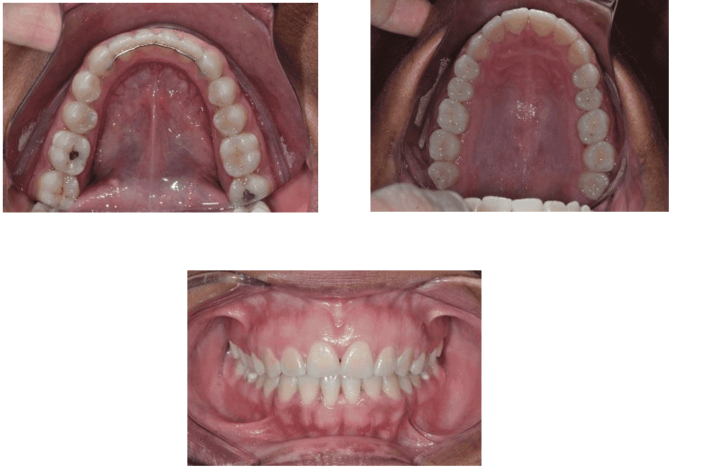 Boca Aberta Com Língua Para Fora E Dentes Incisivos Superiores